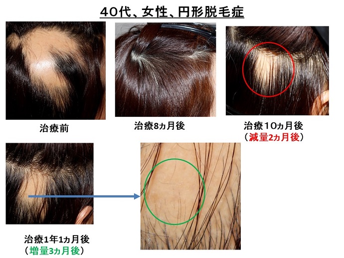 円形脱毛症　病院